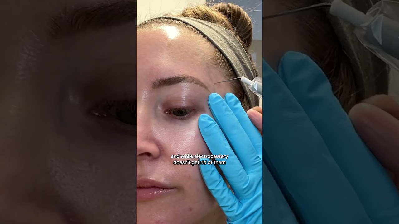 Sebaceous Hyperplasia Treatment