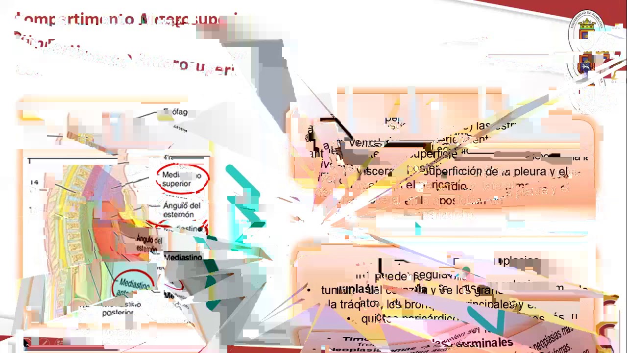 SEMINARIO: &ldquo;TUMORES DEL MEDIASTINO: TIMOMA&rdquo;. Estudiantes VIII Semestre UPA. 9/09/2020