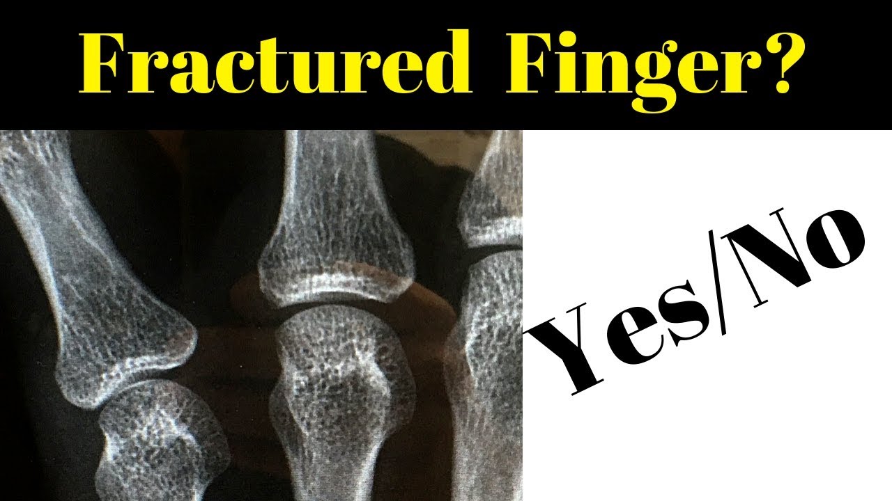 Is my finger broken? (HOW TO TELL)