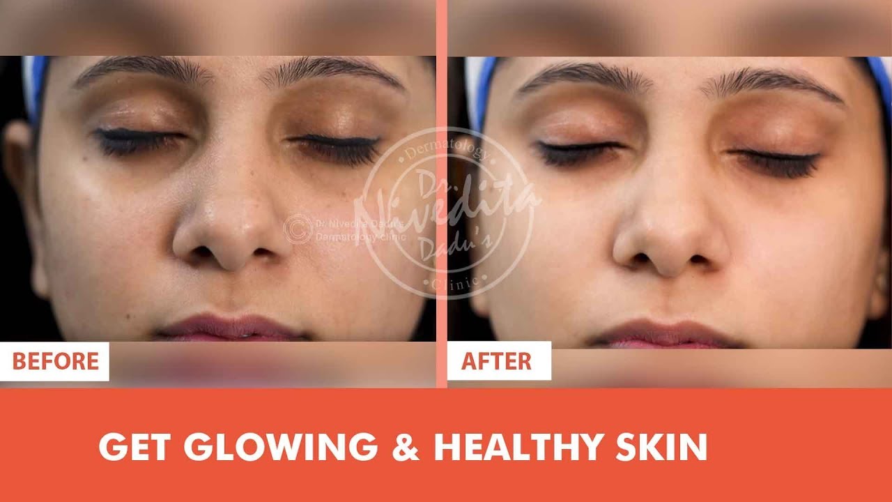 Instaglam Treatment for Glowing and Healthy Skin
