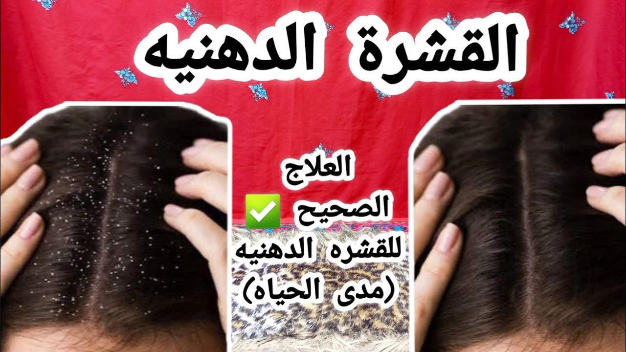 العلاج الصحيح للقشره الدهنيه مدى الحياة  The true  treatment for oily dandruff forever