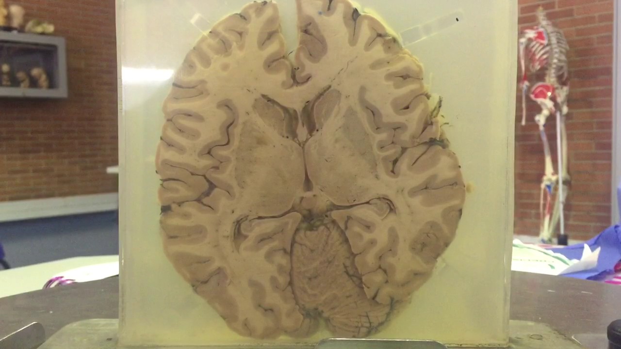 Corte Axial o transversal del encéfalo. Cerebro real parte 1