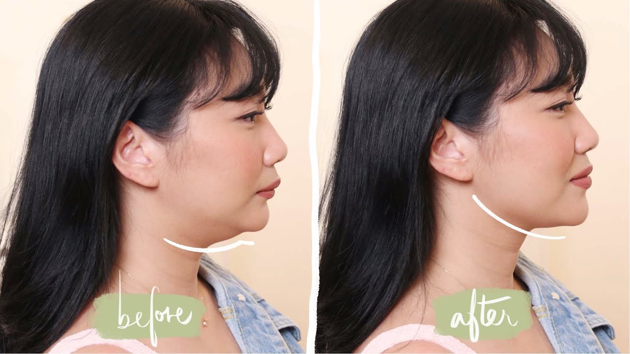 Goodbye, OVERBITE. ❤️ (Veneer Story Part 2) | Raiza Contawi