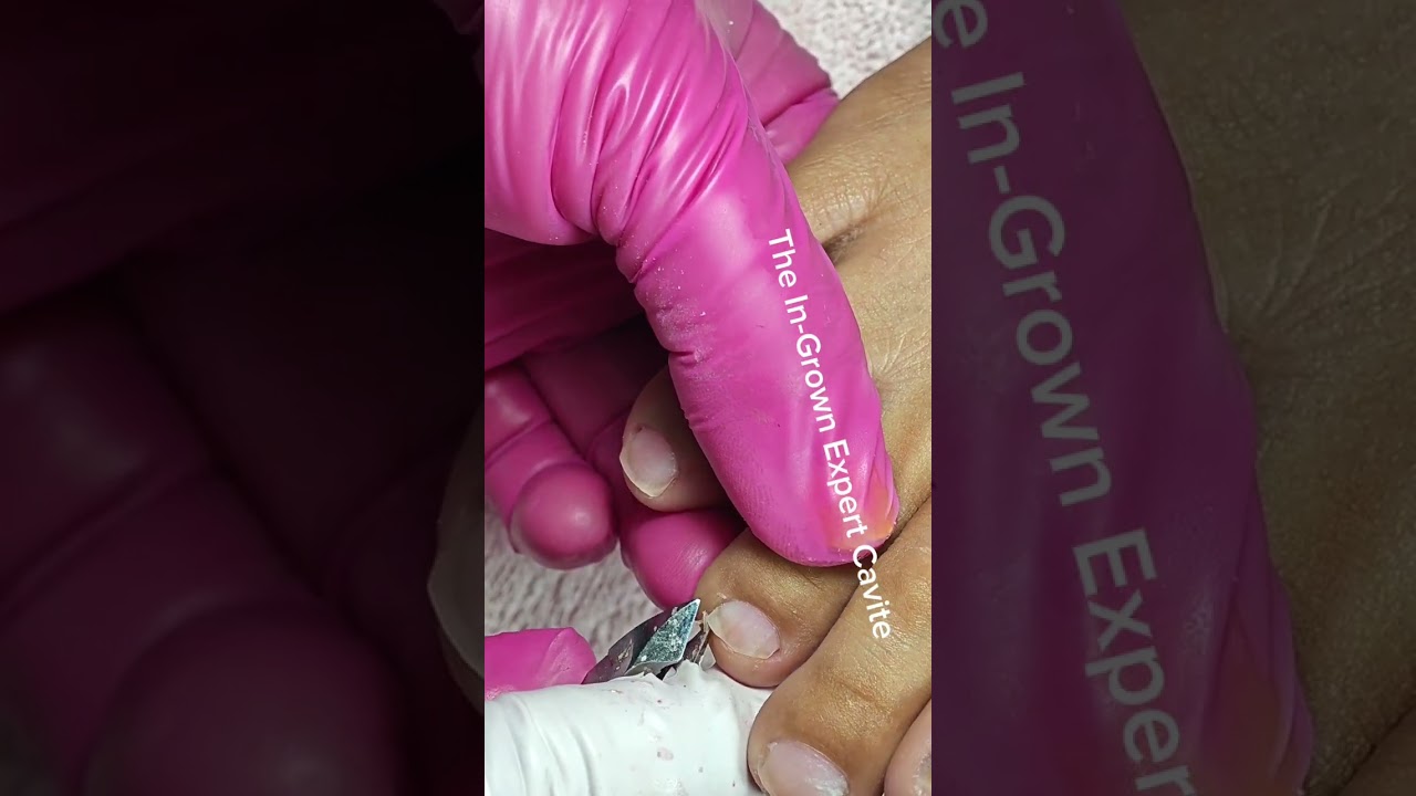 Full video pedicure with ingrown removal 