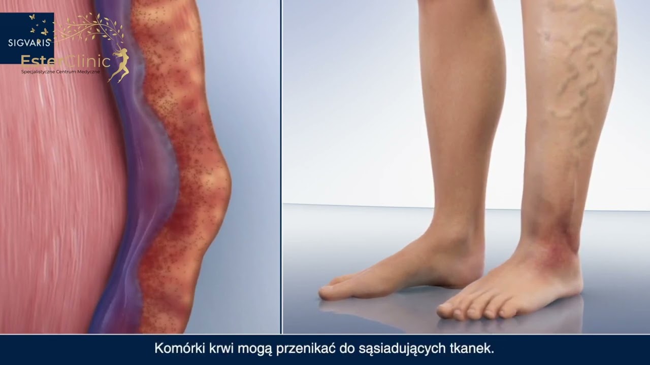 Leczenie chor&oacute;b naczyń żylnych, tętniczych, układu limfatycznego - Angiolog Mateusz Gajda - Jaworzno