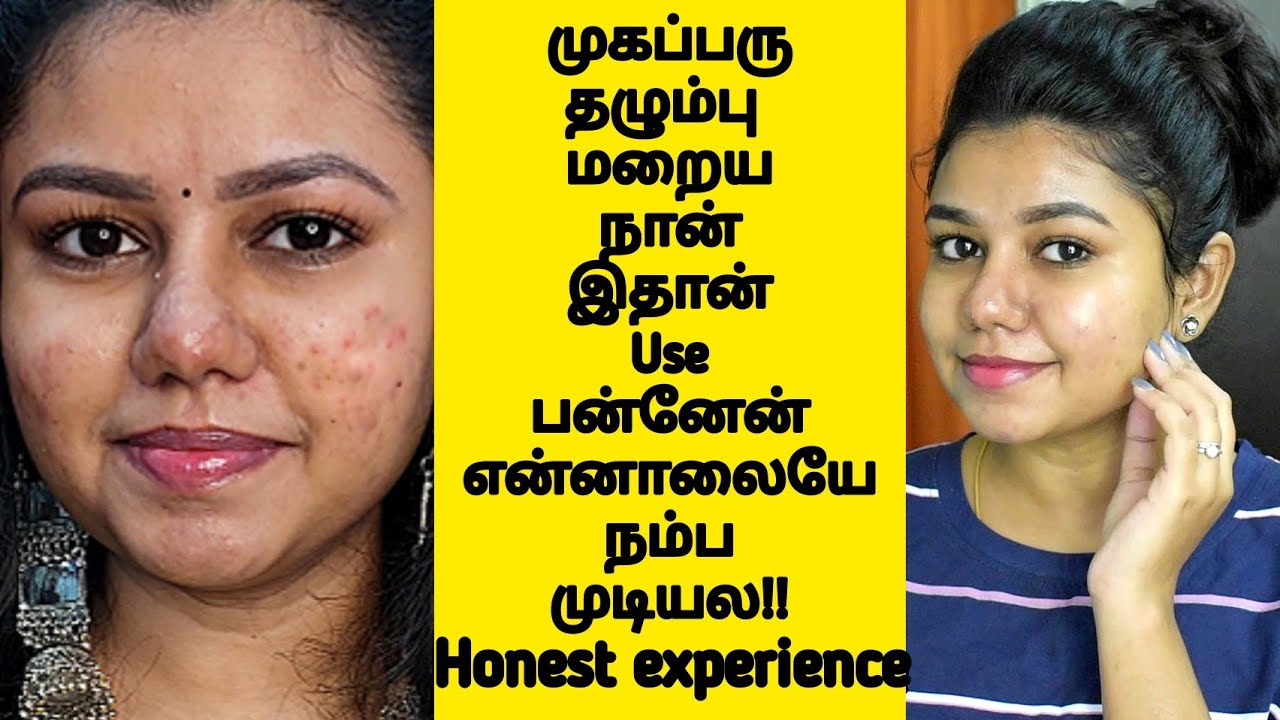 How i reduced my acne marks/spots | How to remove Pimple mark|How to remove acne, acne marks quickly