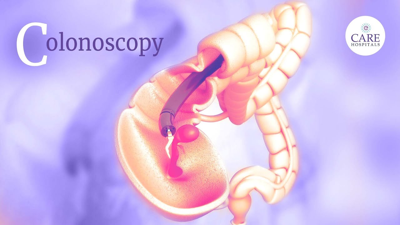 What Happens During and After a Colonoscopy? |  How to Prepare for a Colonoscopy?