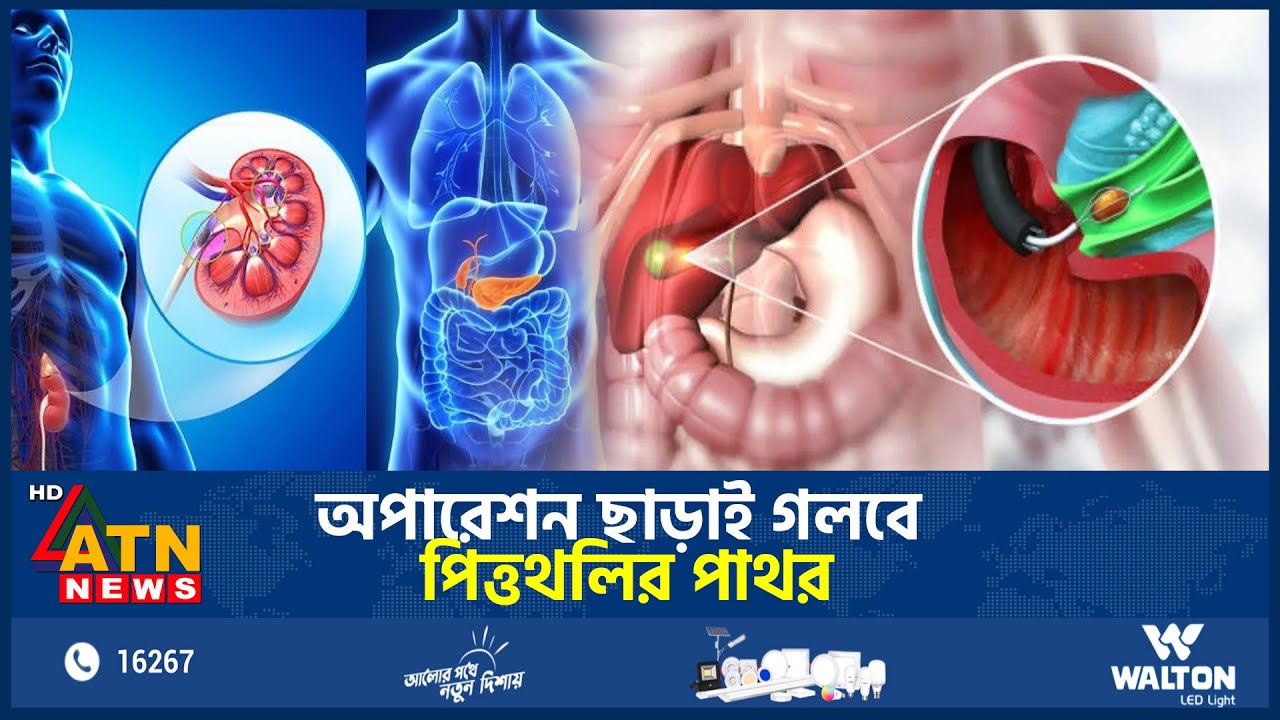 অপারেশন ছাড়াই গলবে পিত্তথলির পাথর | Remove Gallbladder Stone | Without Surgery | ATN News