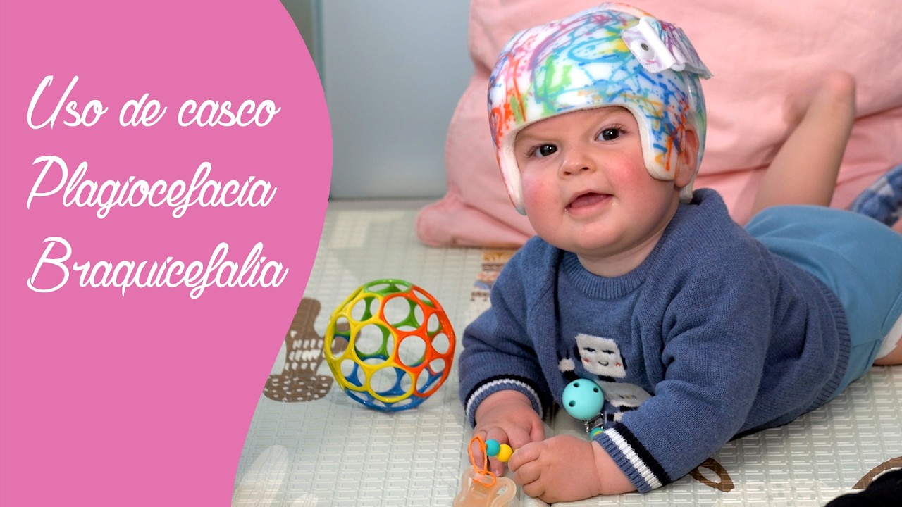 Uso del CASCO para plagiocefalia o braquicefalia. Experiencia Real de una Mamá | Consejos y Cuidados