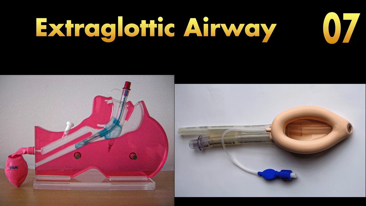 Extraglottic Airway: Supraglottic and Retroglottic Devices, Advantages and Disadvantages