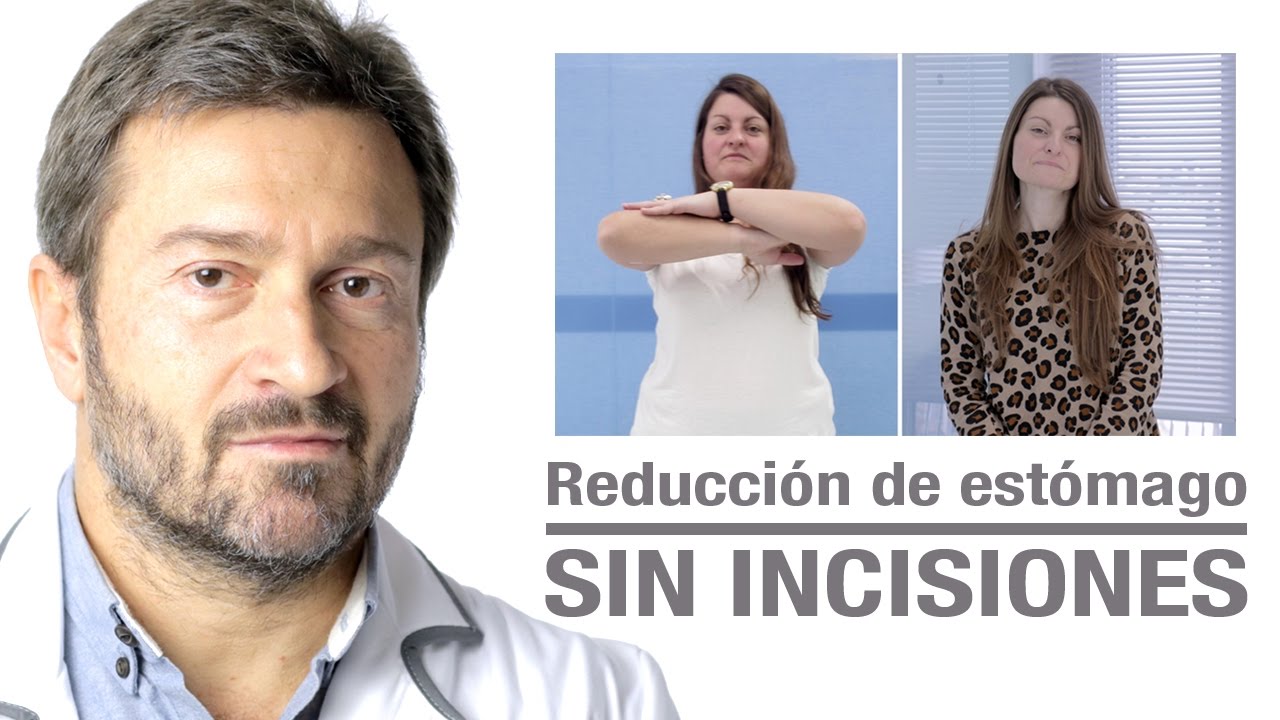 Método POSE | Reducción de estómago sin incisiones