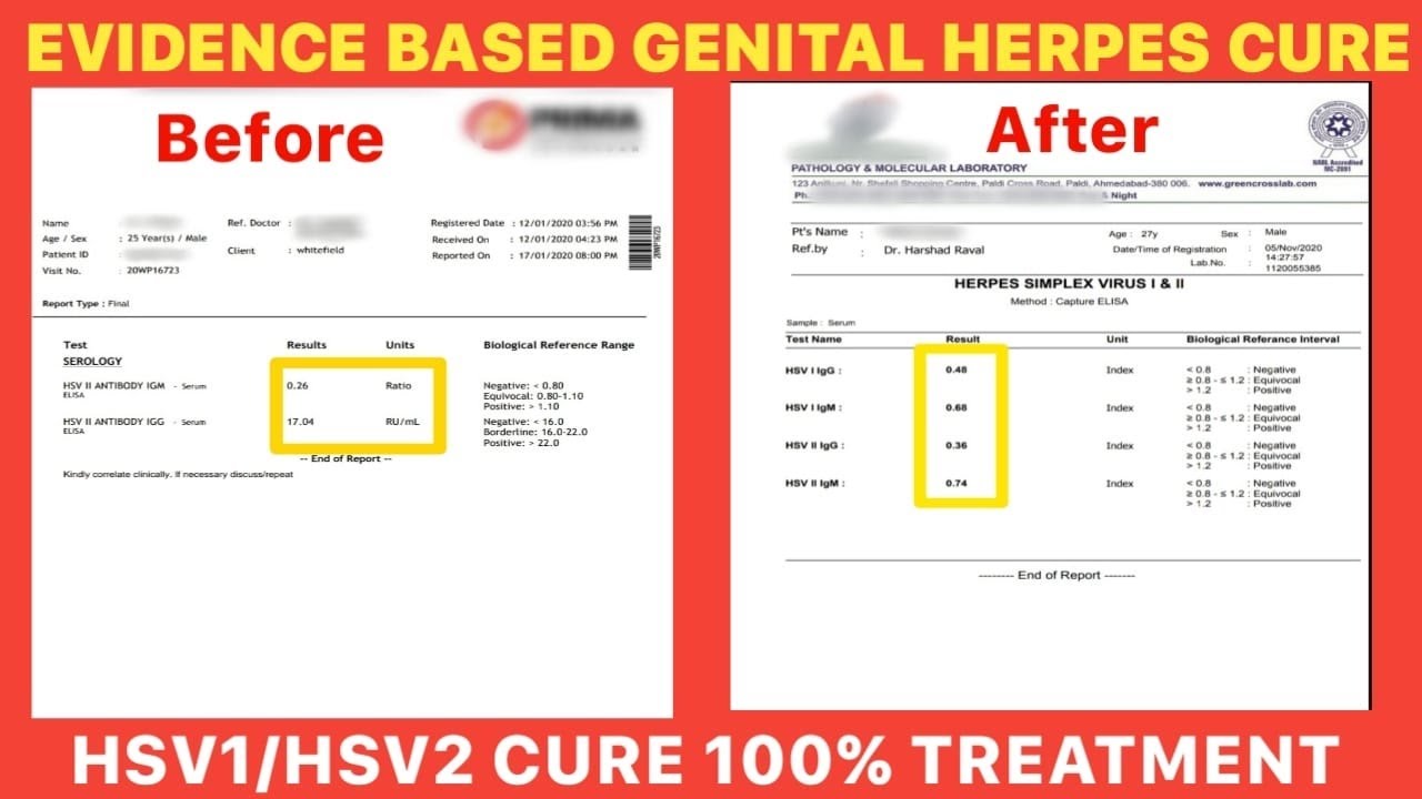 Genital herpes? hsv1 & hsv2 evidence based cure l हर्पिज रोग का आसान और पक्का इलाज  l 100% cure