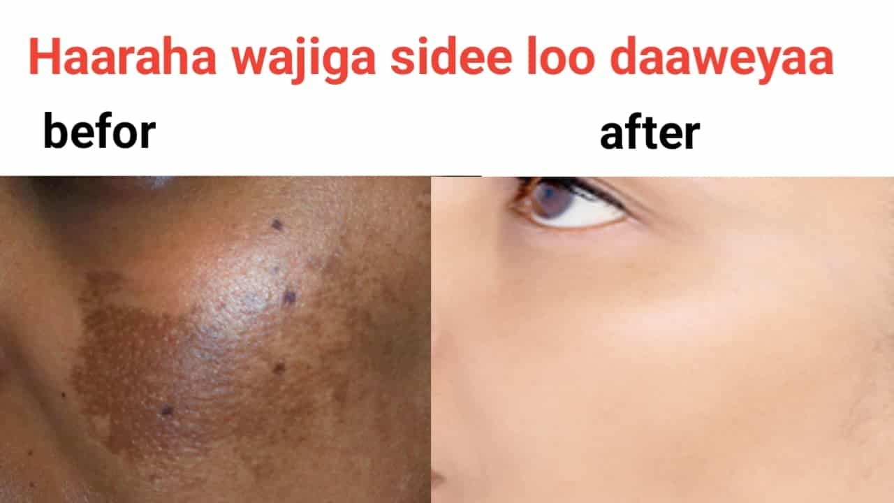 Haaraha  wajiga sida loo daweeyo iyo sida Loga hortago
