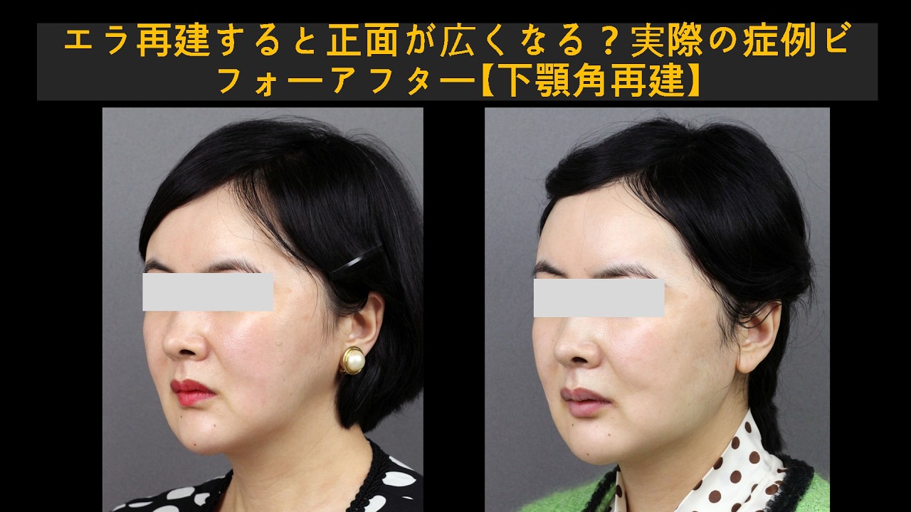 エラ再建すると正面が広くなる？実際の症例ビフォーアフター【下顎角再建】