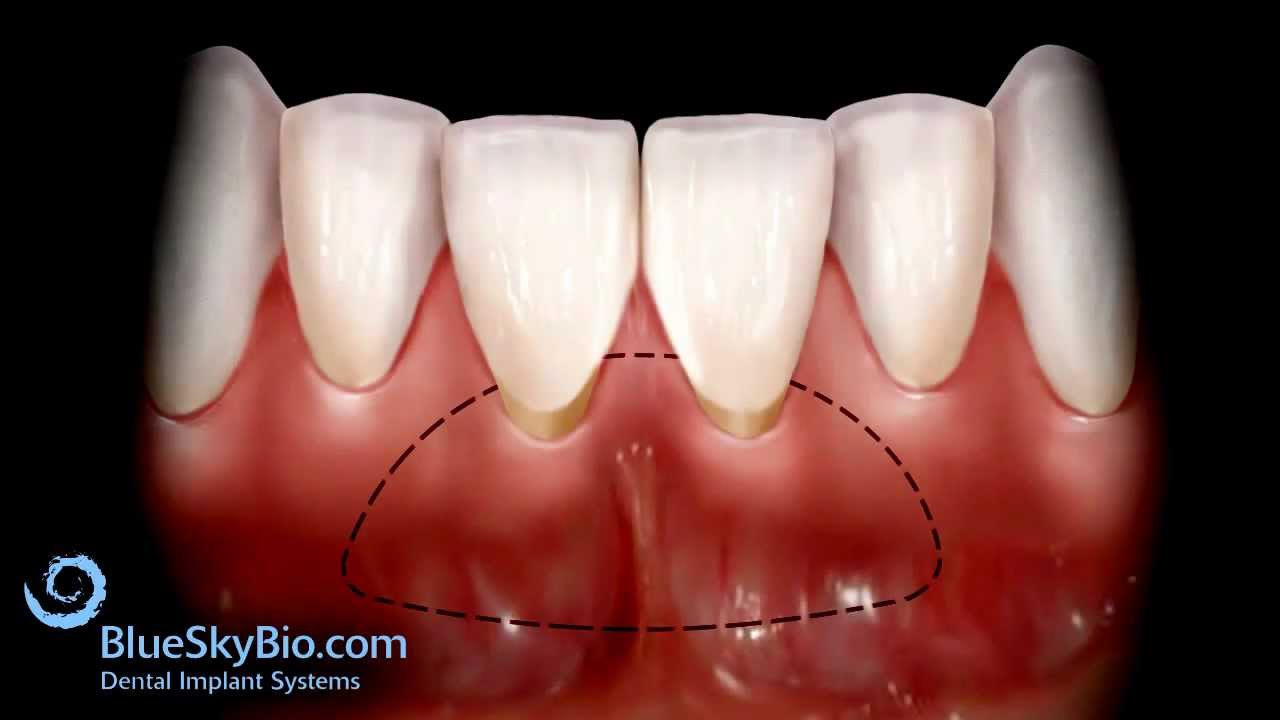 Patient Treatment Videos: Free Gingival Graft