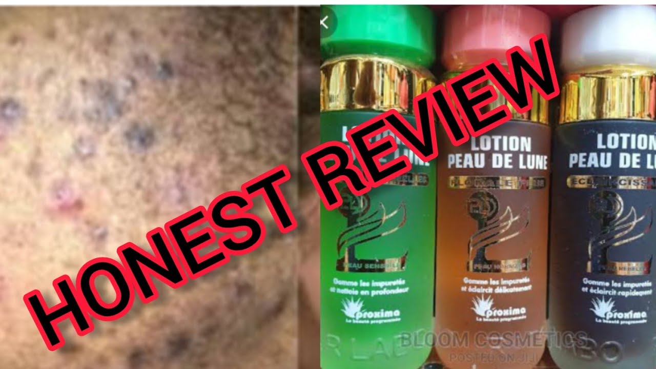 GET RID OF EXTREME ACNE-PIMPLES WITH PEAU DE LUNE CLEANSER/ BEST FACIAL CLEANSER FOR SUNBURN, ACNE