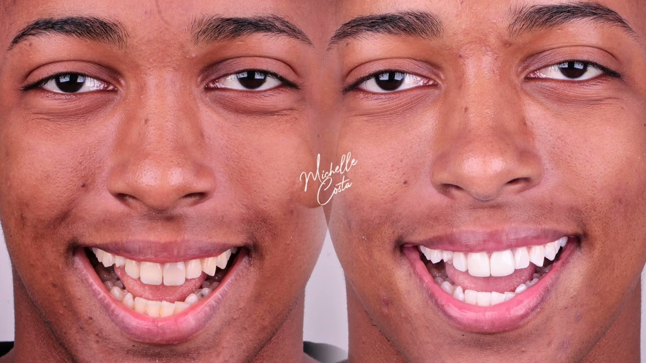 Transformação com Lentes em Resina | Antes e Depois Incrível em Madureira - Rio de Janeiro