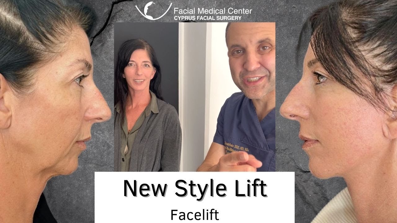 New Style Lift Facelift |Cyprus Facial Surgery