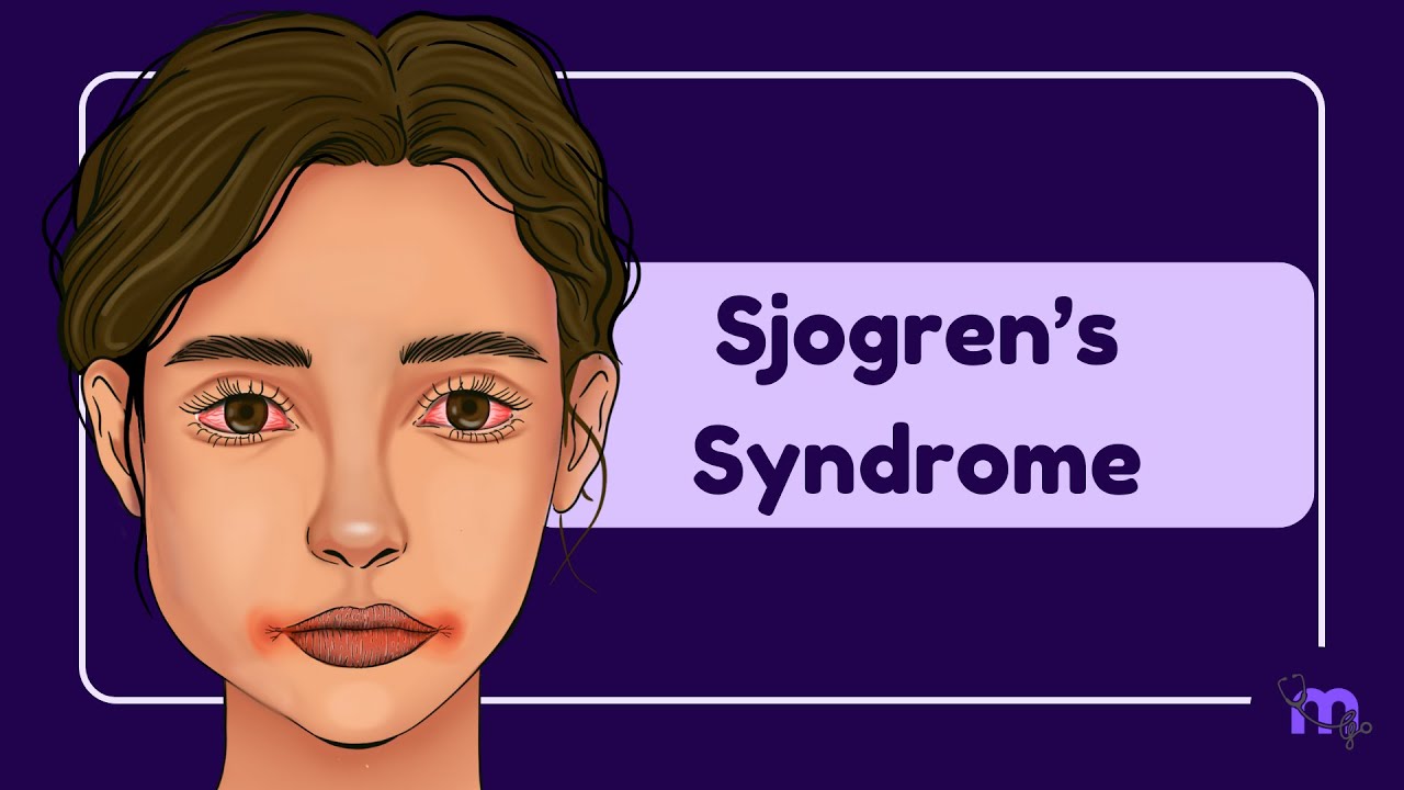 Sjogren Syndrome - Symptoms, Complications, Diagnosis & Management