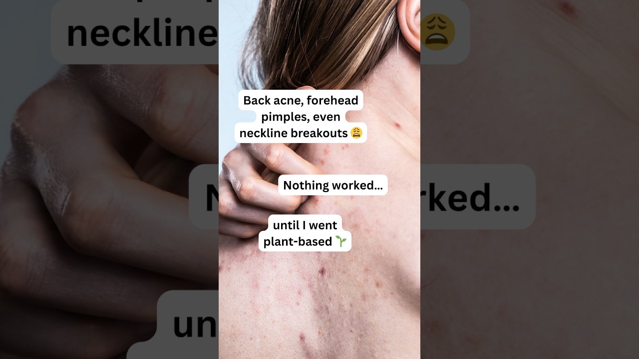 Back Acne & Forehead Pimples | Clear Skin Tips That Actually Work 