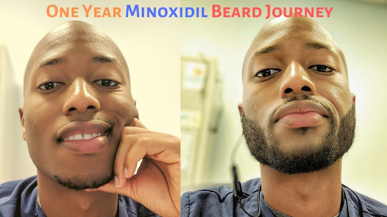 How I Grew A Beard in One Year: My Minoxdil Beard Journey