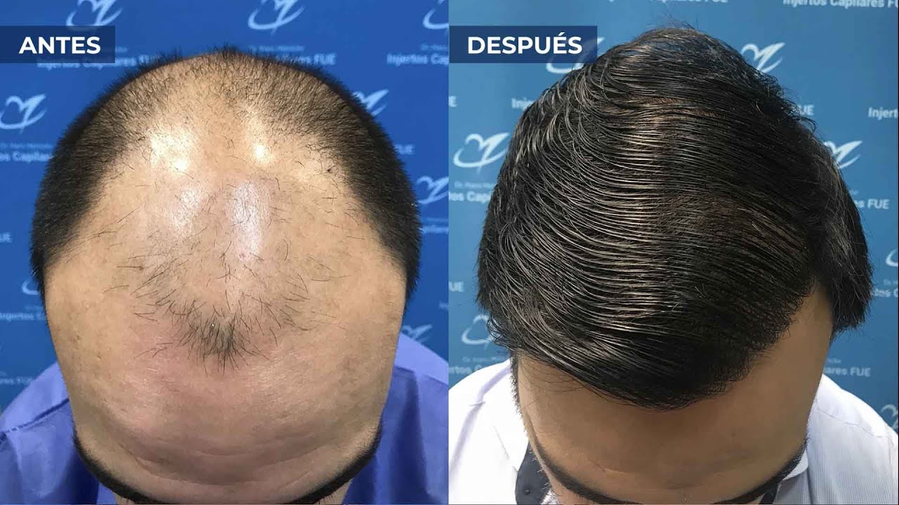 Injerto Capilar en Barcelona