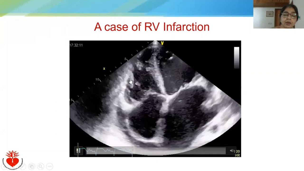 Philips Echo Webinar Series Echo Evaluation of Ischemic Heart Disease by Prof  Dr  Tuhin Haque, NHF