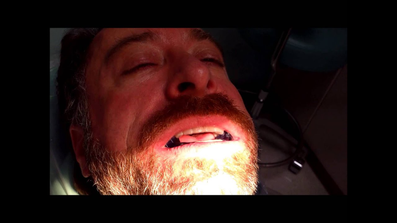 The Moses Appliance for Sleep Apnea