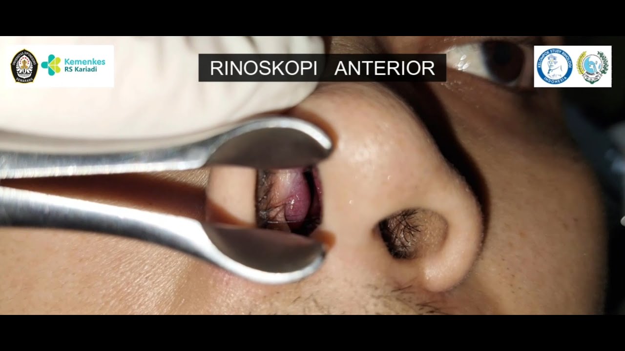 Nasal and Paranasal Sinus Examination