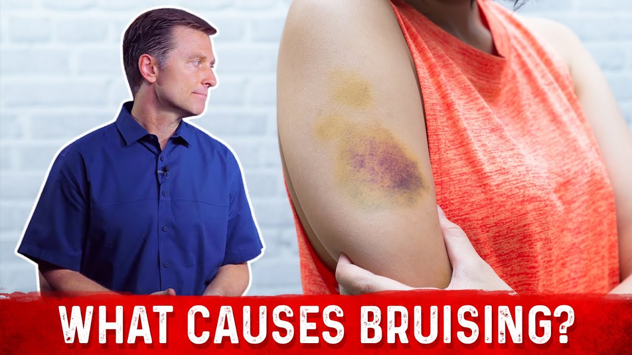 What Causes Bruising (Without Trauma) &ndash; Dr. Berg