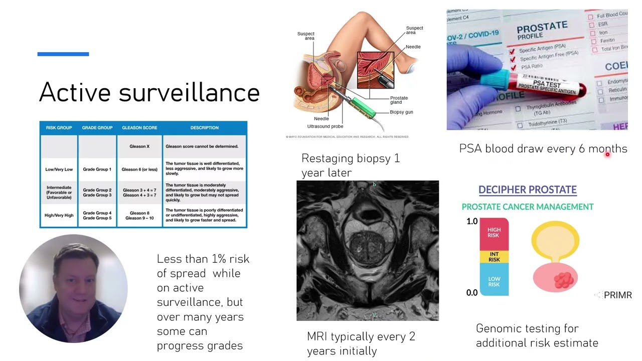 Prostate Cancer The Talk