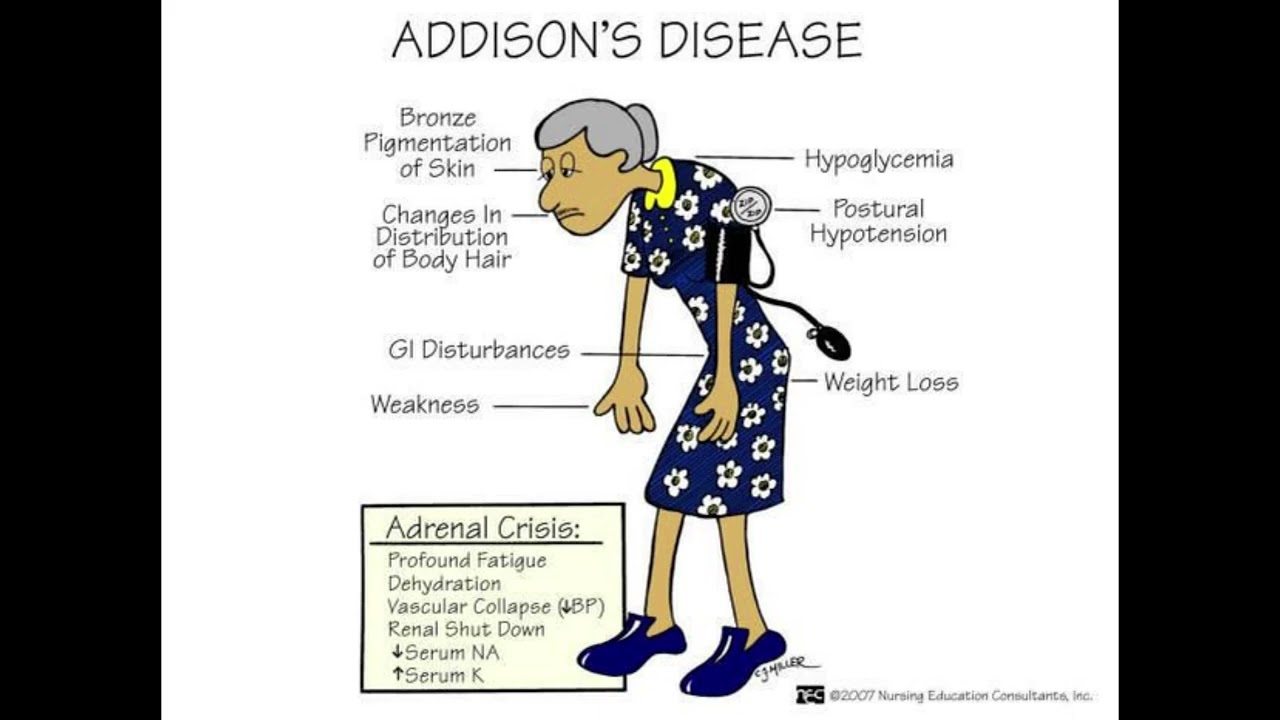Addison's Disease Explained: Symptoms, Causes, and Treatment