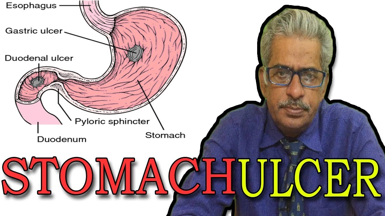 Stomach Ulcers in Hindi - Discussion and Treatment in Homeopathy by Dr P.S. Tiwari