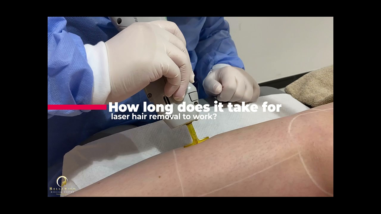 Laser hair removal in Dubai by Candela Gentle max pro
