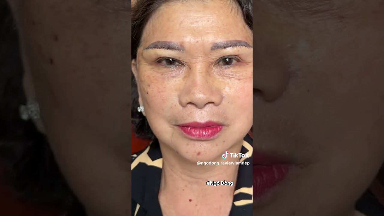 nâng cơ táo không phẩu thuật