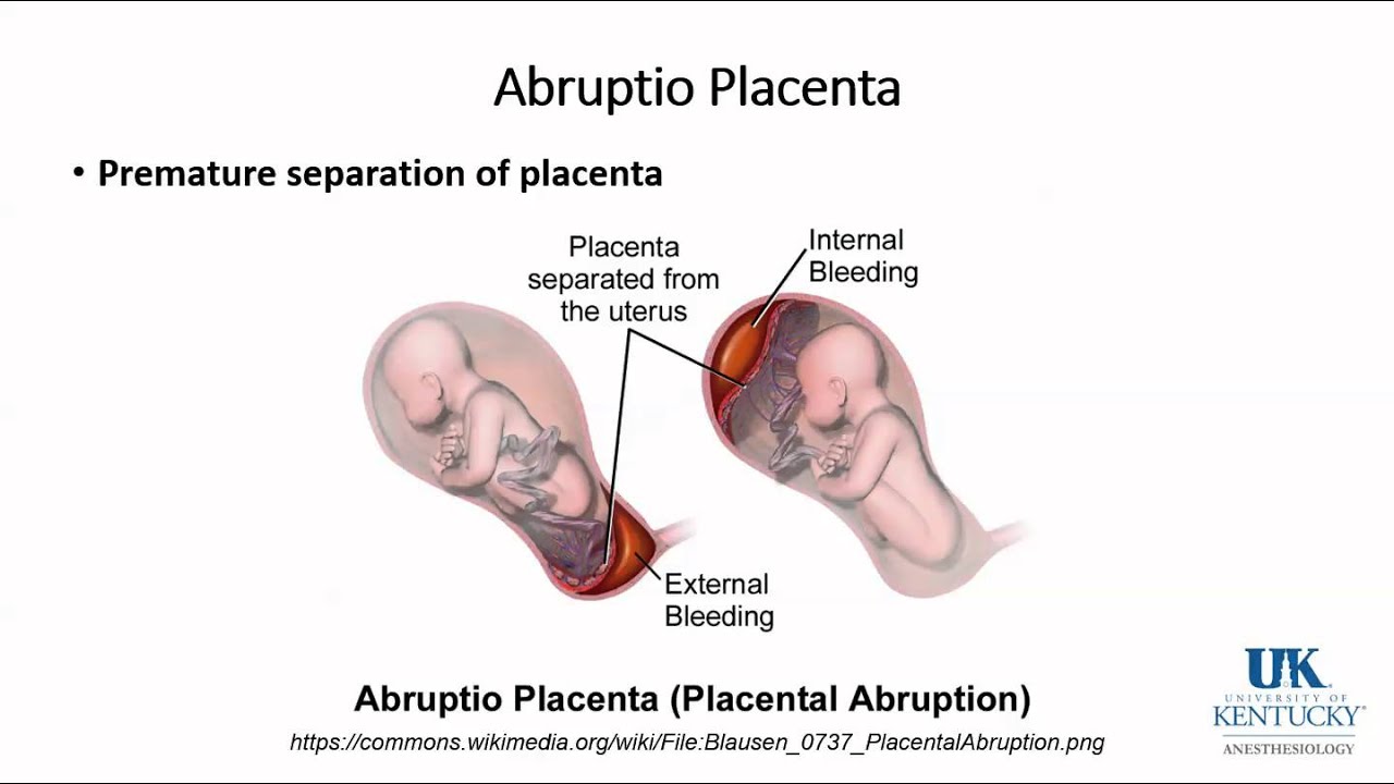 Obstetric Hemorrhage - Dr. Fragneto