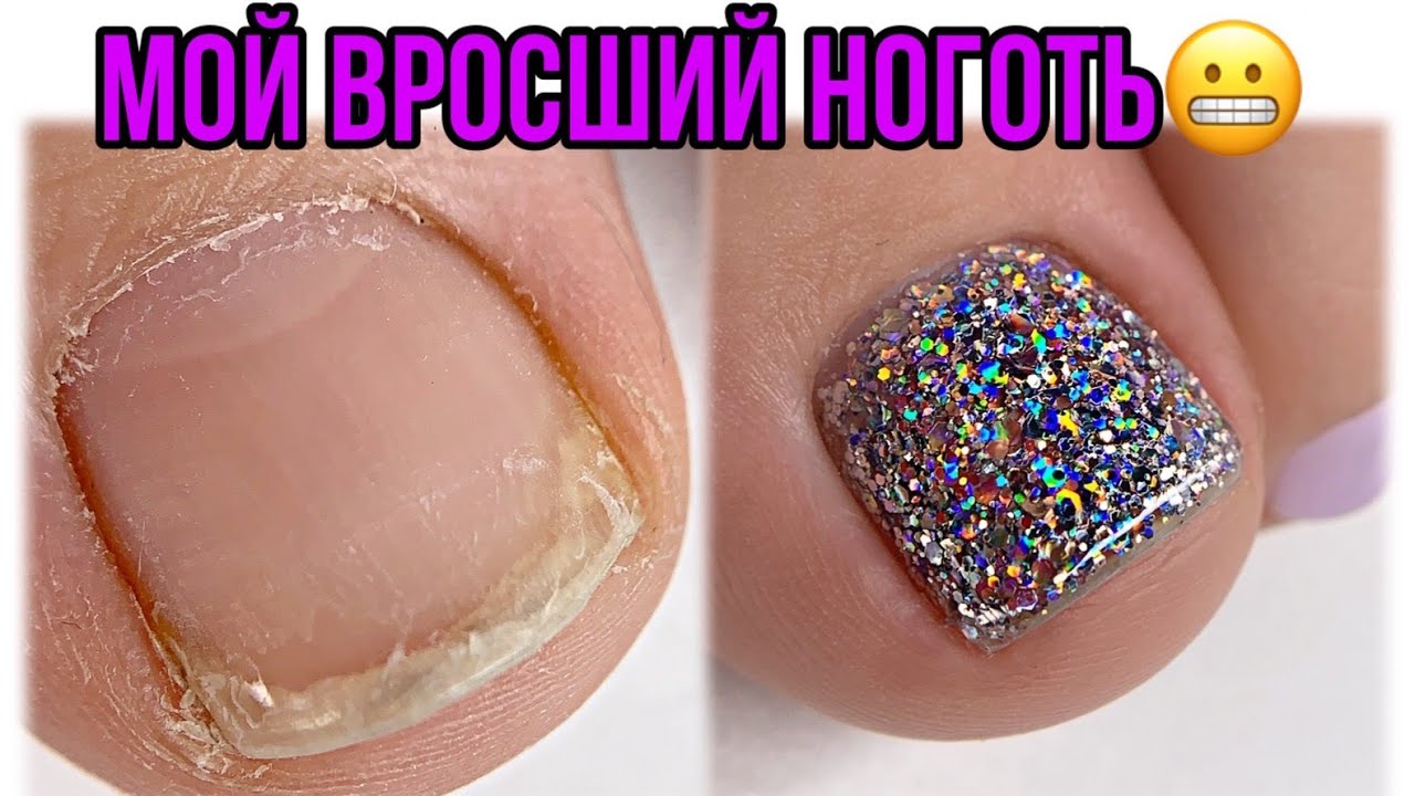 Мои жуткие ногти😱Вросший ноготь😕Педикюр в домашних условиях