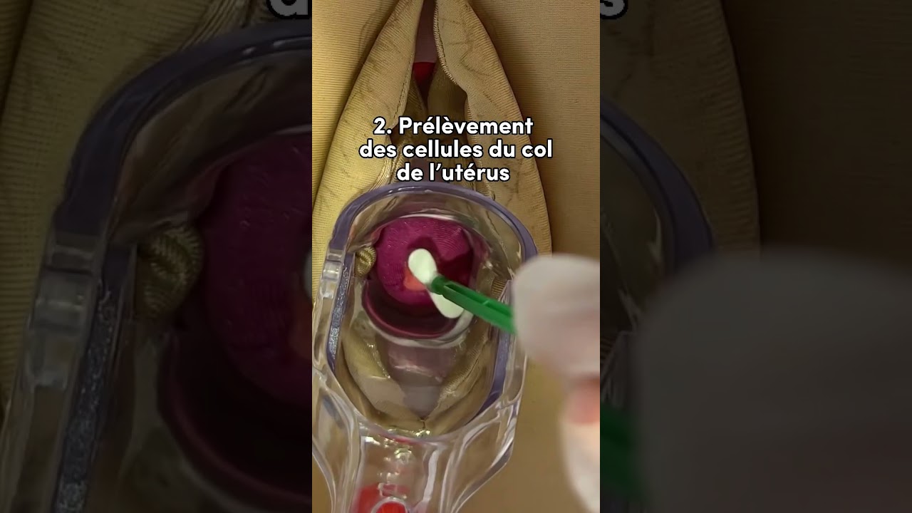 R&eacute;alisation d&rsquo;un frottis cervico uterin (pour recherche cancer du col de l&rsquo;ut&eacute;rus)