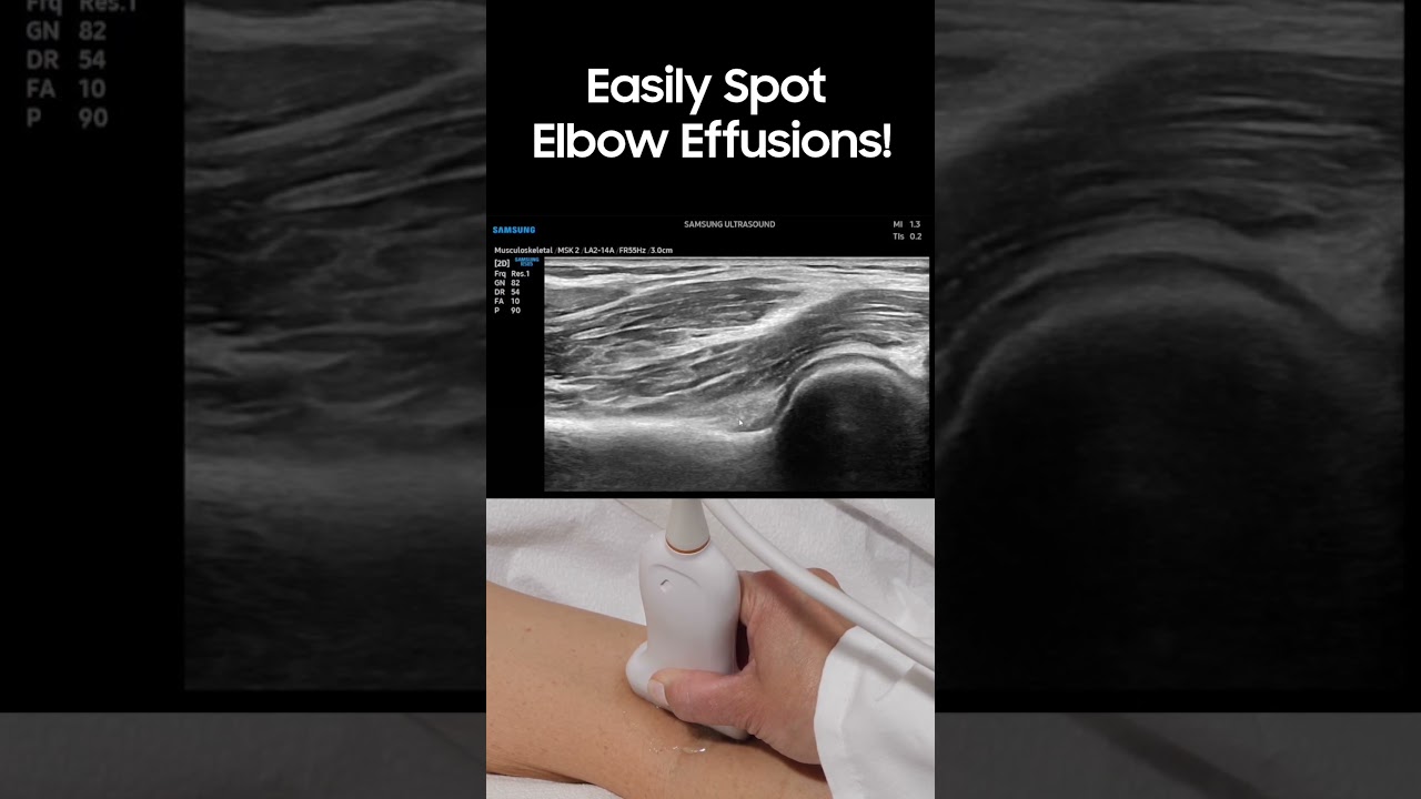 Spotting Elbow Joint Effusions Easily