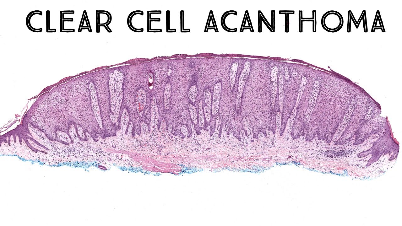 Clear cell acanthoma (pathology dermpath dermatology dermatopathology)