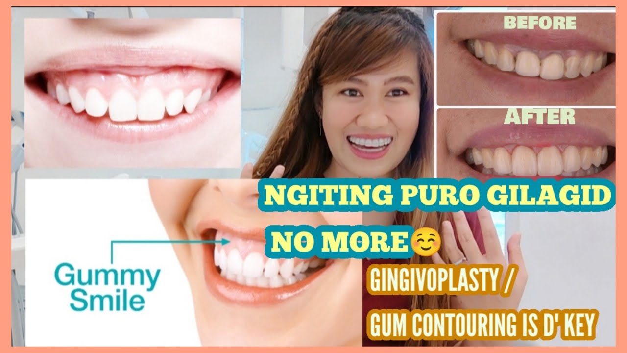 MAGILAGID NO MORE GINGIVOPLASTY / GUM CONTOURING IS THE KEY
