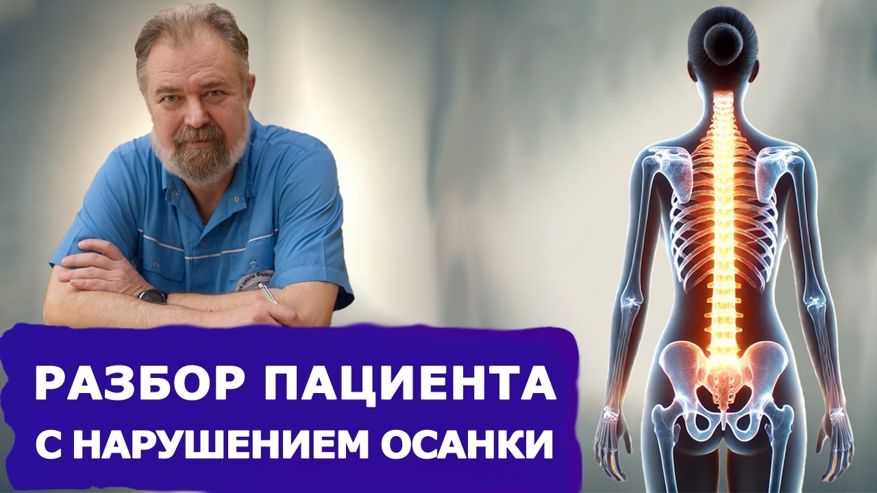 Как исправить осанку за 1 прием? Разбор пациента со сколиозом