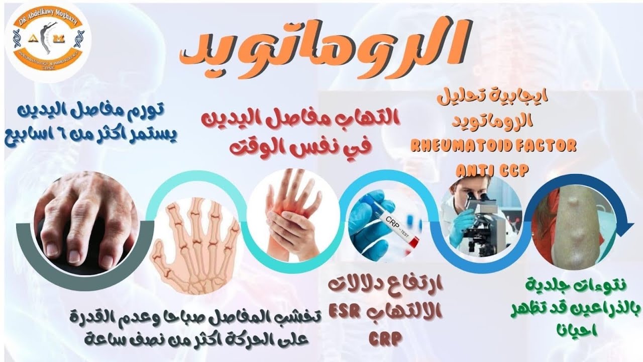 الفرق بين الروماتويد السلبي و الفيبروميالجيا واهم سبب لتشخيص الروماتويد الخاطئ/ اد عبدالقوي مغازي
