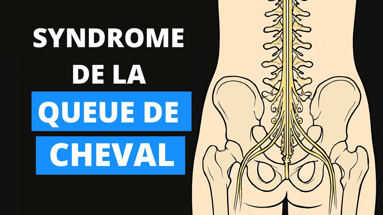 Syndrome de la Queue de Cheval : Les sympt&ocirc;mes qui doivent vous alerter