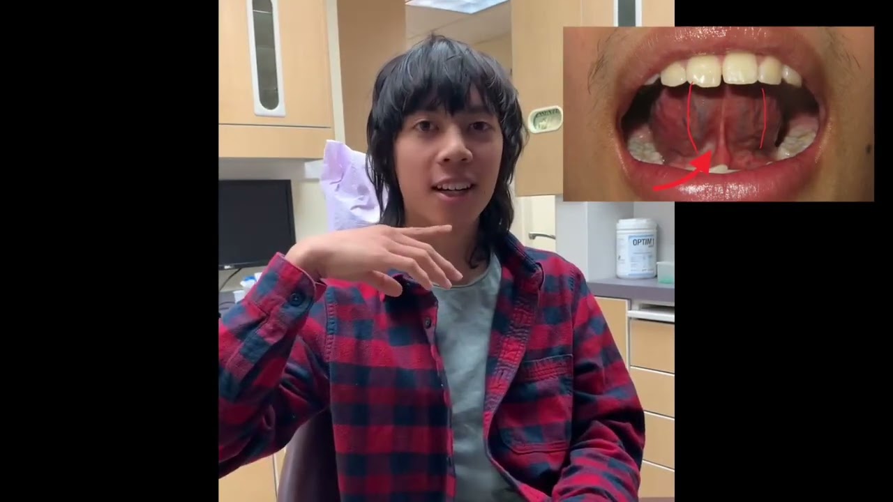 ✨ Patient Testimonial | Lingual Frenectomy with a CO2 Laser ✨@lightscalpel