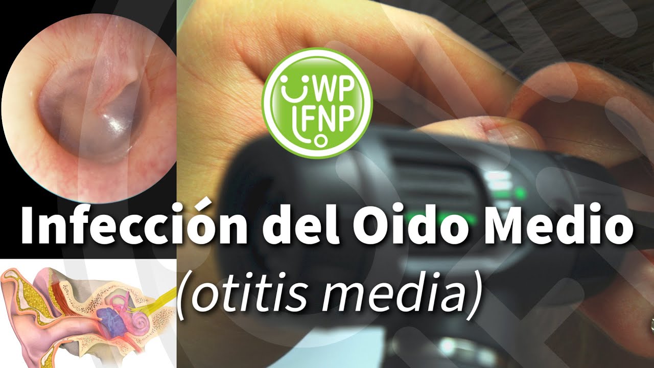 Infección del Oido Medio (otitis media)