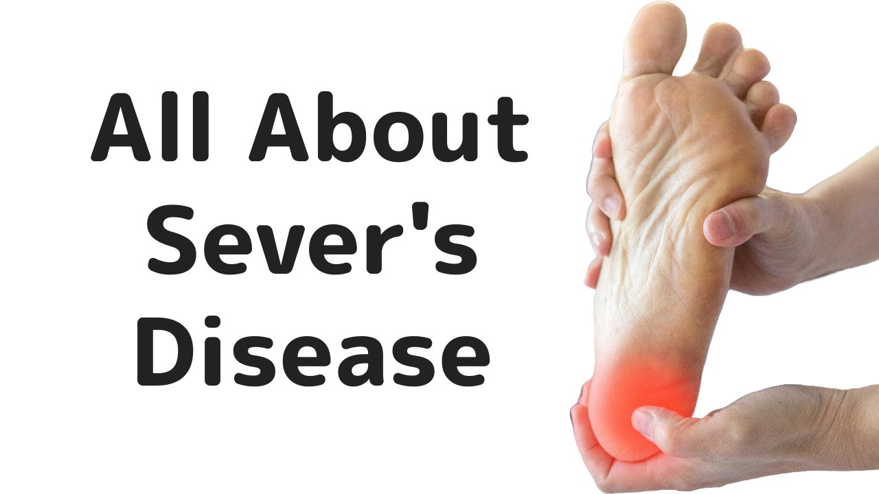 Sever's Disease or Calcaneal Apophysitis