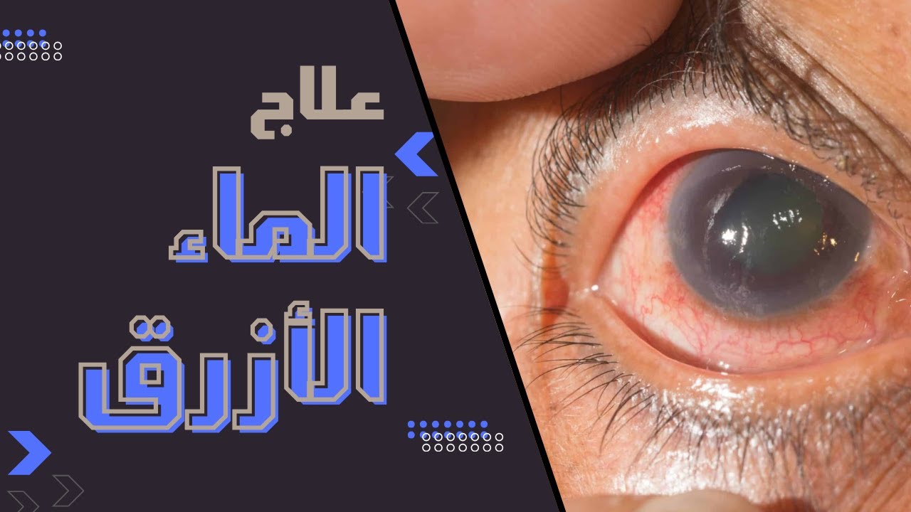 شرح ادوية الگلوكوما ( الماء الازرق ) | Eye | Glaucoma