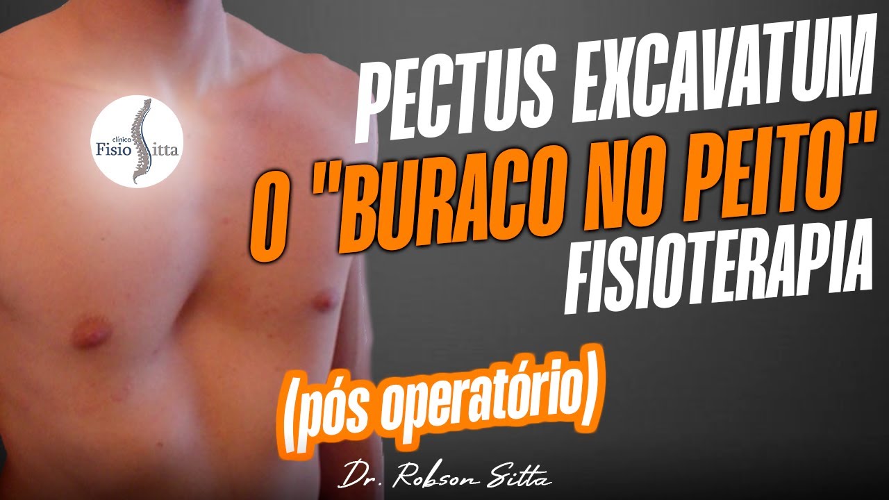 PECTUS EXCAVATUM ou PEITO ESCAVADO DEPRESSÃO NA CAIXA TORÁCICA PÓS CIRURGIA Clínica Dr. Robson Sitta