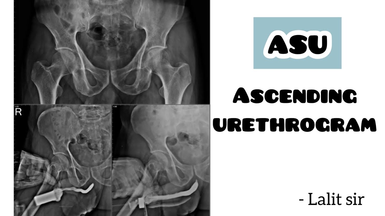 Ascending urethrogram | ASU | @scparamedicalinstitute8221